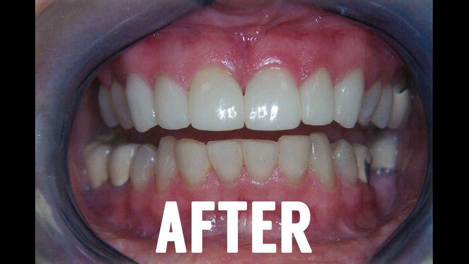 After Dental Crown Procedure