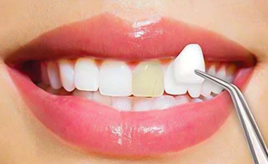 porcelain veeners cosmetic dentistry procedures