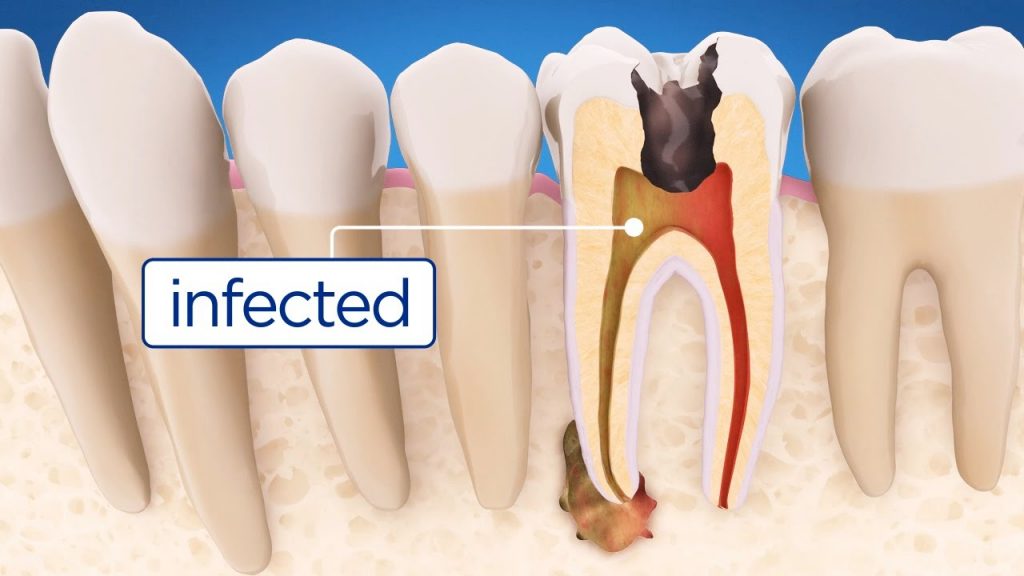 When Do You Need A Root Canal Treatment Procedure Step By Step