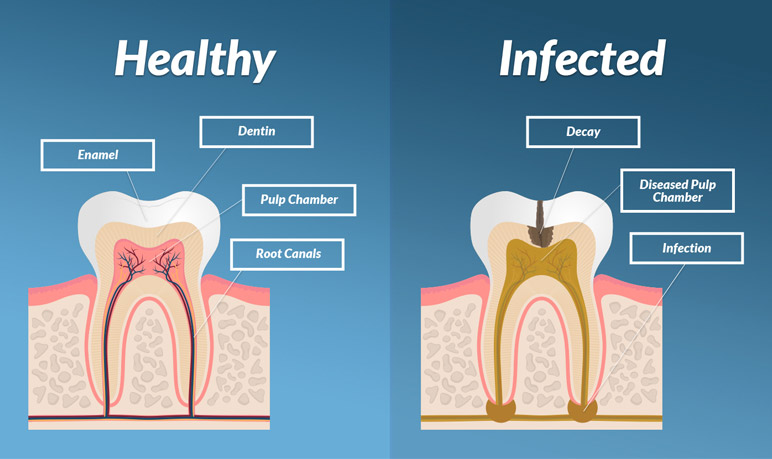 Infected Pulp Inside Tooth
