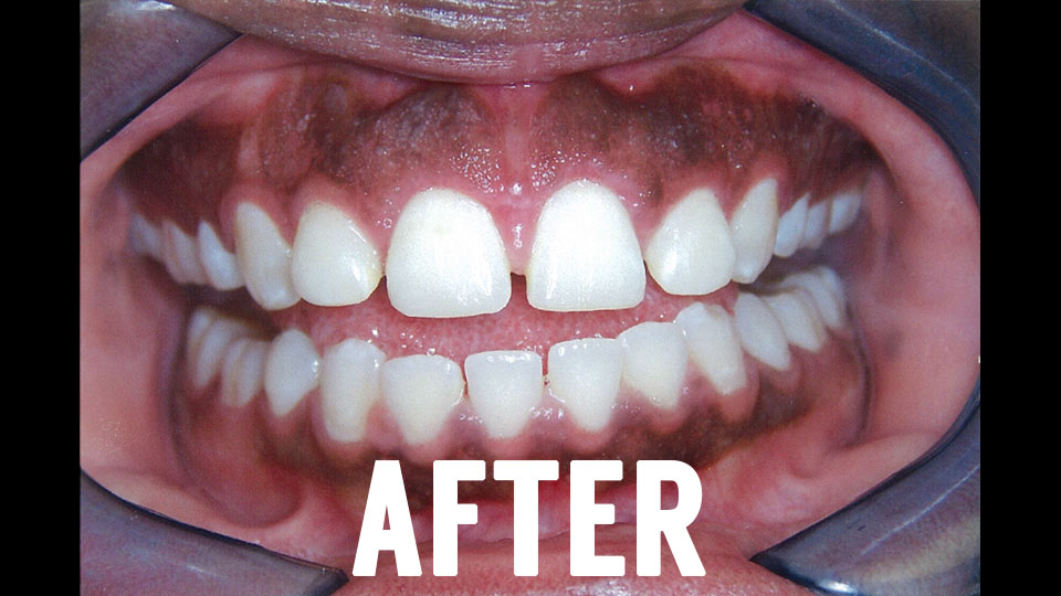 After Dental Laser Surgery