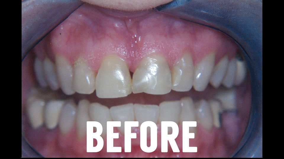 Before Dental Crown Procedure
