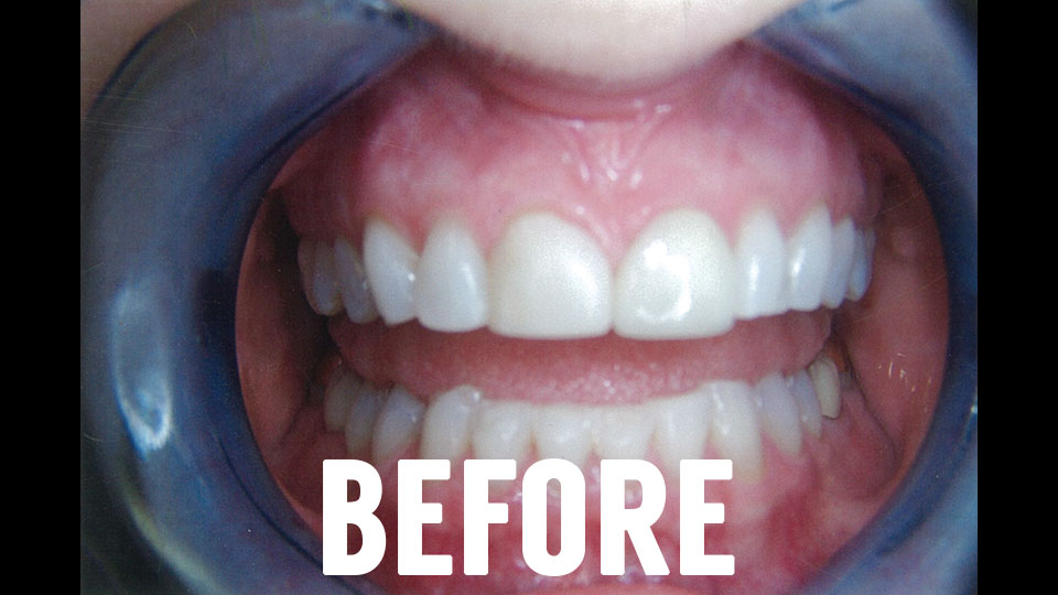 Before Dental Veneers