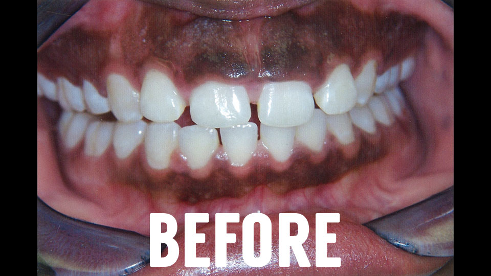 Before Dental Laser Surgery