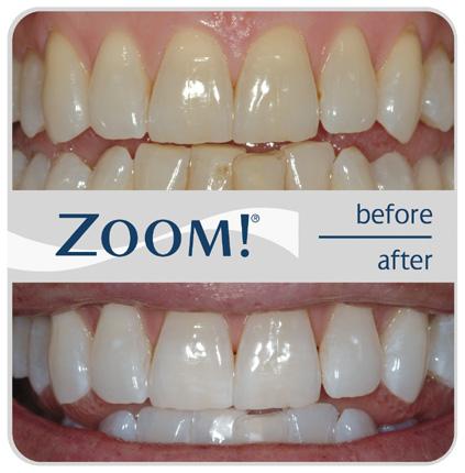 Zoom Tooth Whitening Before After