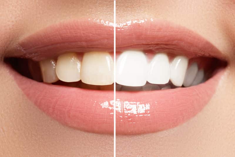 5 Most Affordable Cosmetic Dentistry Procedures - Dr. Fitzgerald