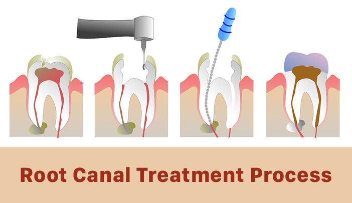 When Do You Need a Root Canal Treatment - Procedure Step by Step
