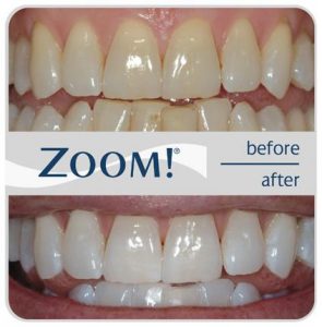 Zoom Teeth Whitening Before & After