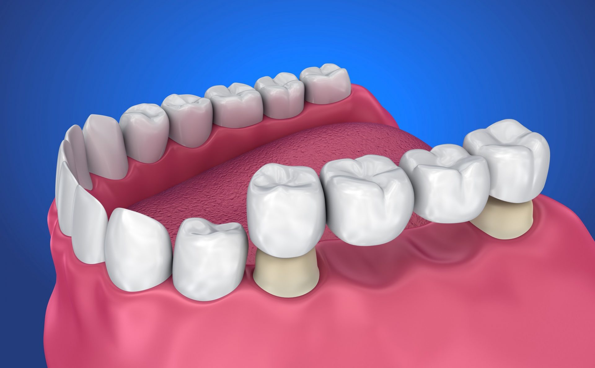 Fixed Dental Bridges