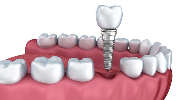 Restoration of Dental Implants