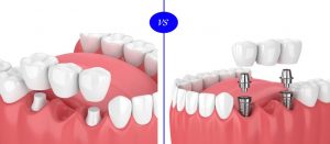 dental implant vs fixed bridge