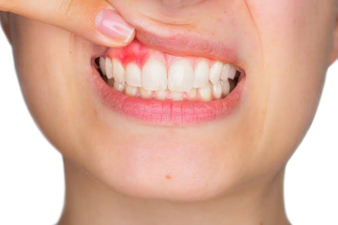 dental abscess antibiotics treatment