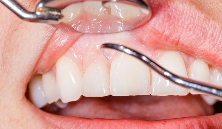 Preventing Gum Disease