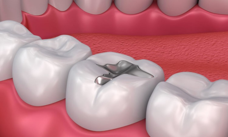 Dental Inlay vs. Filling