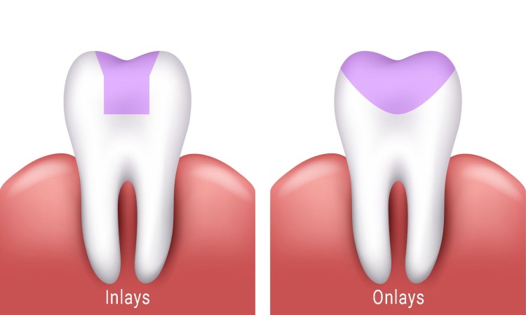 difference between dental inlay and onlay