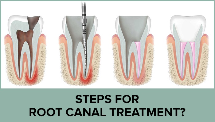 Stages of Root Canal Treatment