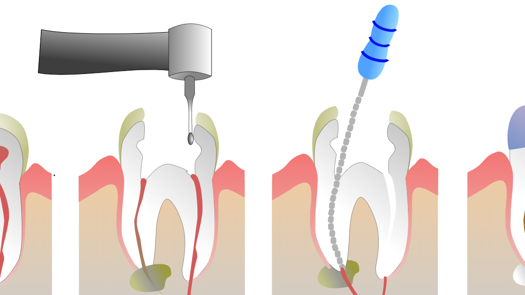Воспаление канала зуба. Эндодонтия корневых каналов.