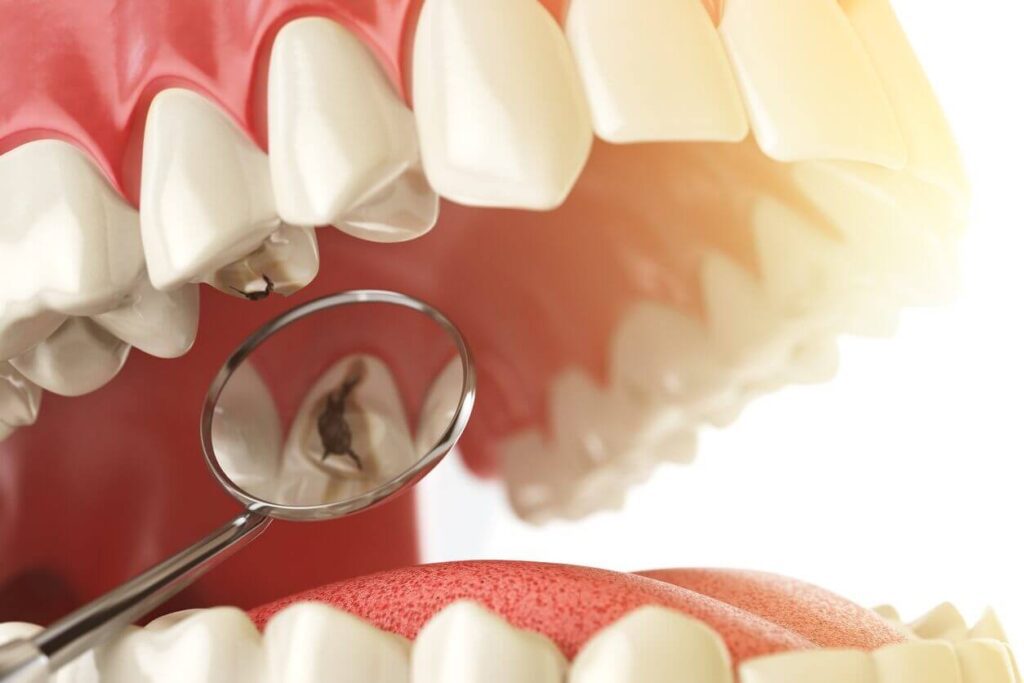 dental sealants procedure