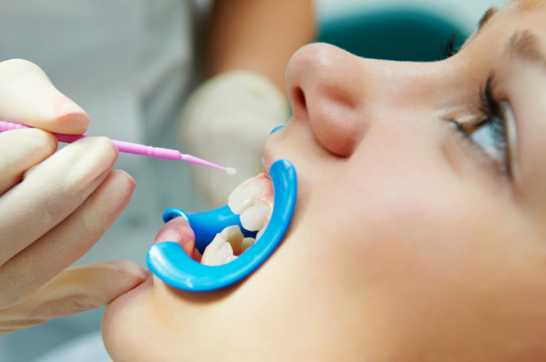dental sealants for kids