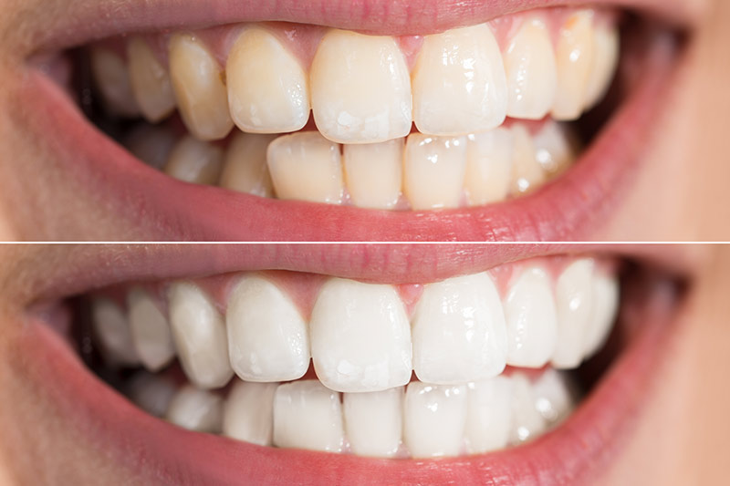 Zoom Teeth Whitening at Fitzgerald Dentistry
