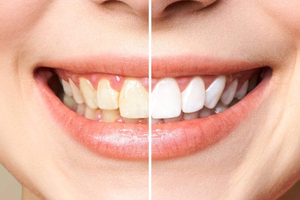 Professional Teeth Whitening Procedure