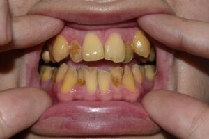 What Causes Yellow Teeth & It's Treatment